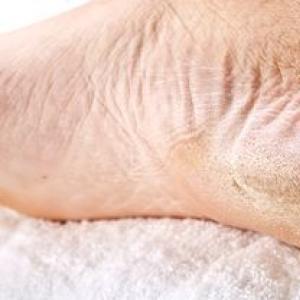 Cracked heels - causes, treatment at home
