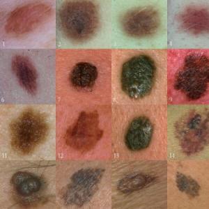 Warts: what are they and what do they look like?